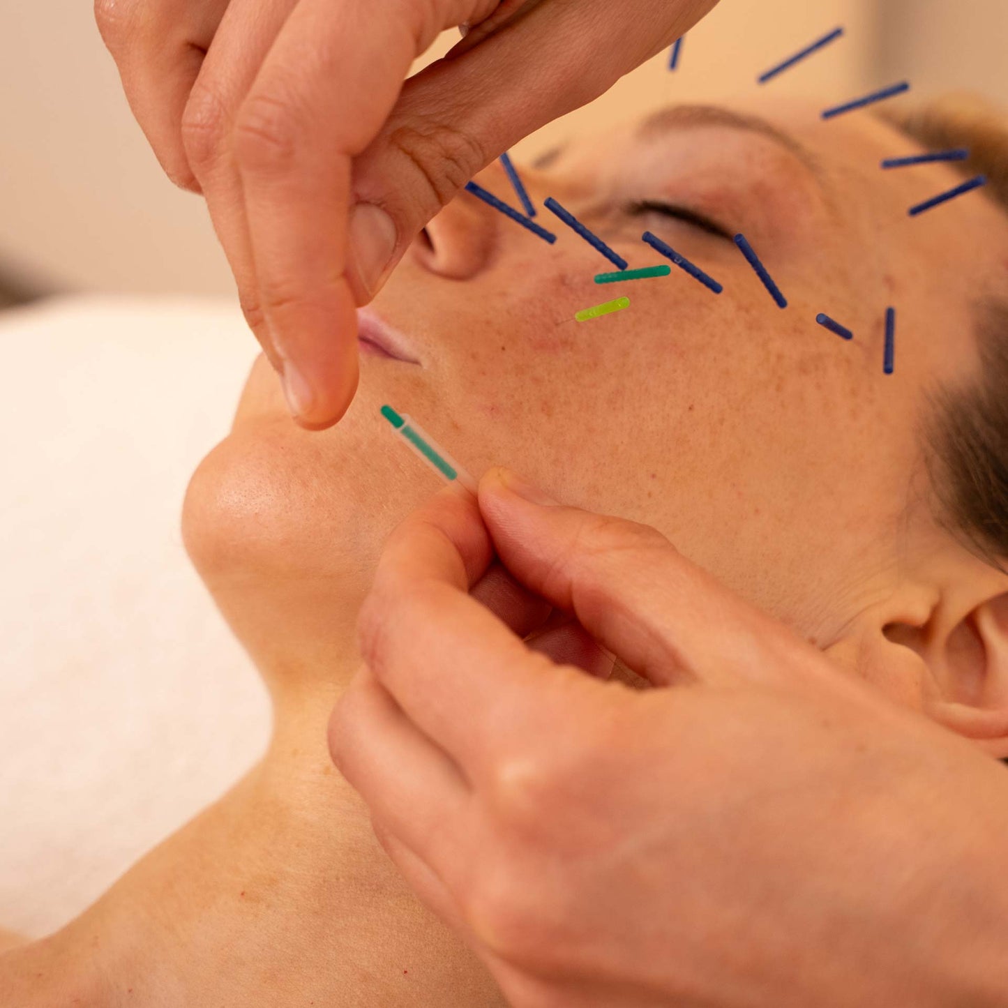 Cosmetic & Medical Acupuncture